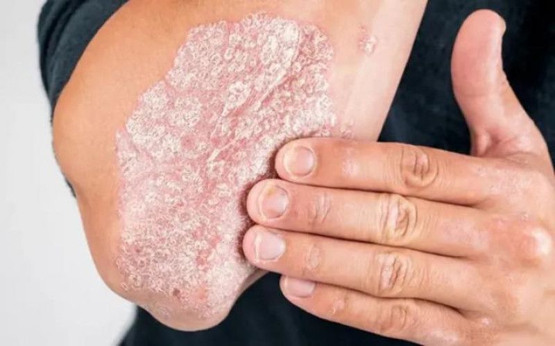 La ANMAT aprobó un nuevo medicamento para la psoriasis.